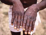 Monkeypox cases reported: What you need to know