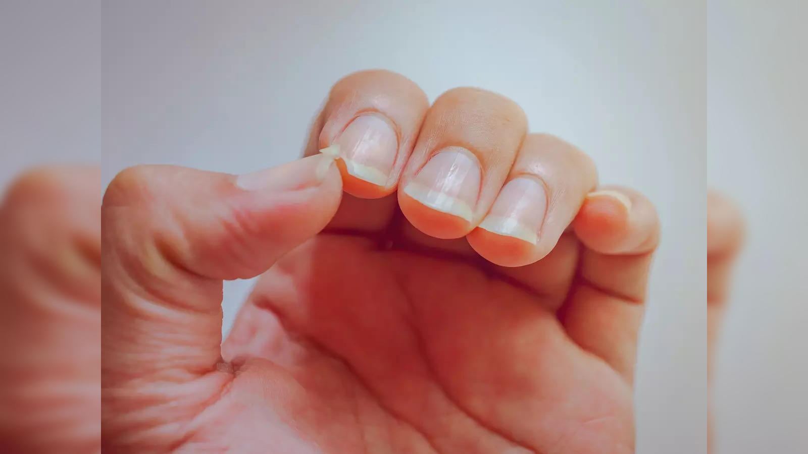 How to Survive Splitting Nails. Causes & Remedies. - YouTube