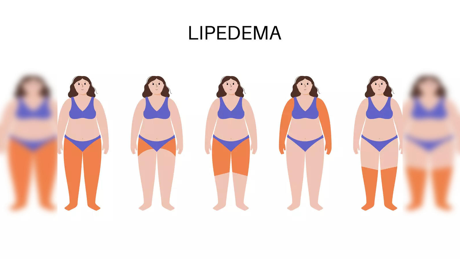 Conservative Treatments for Lipedema 