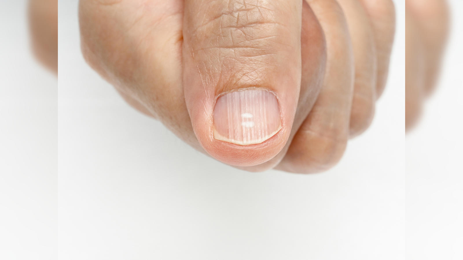 Fingernail Bed Inflammation, Bacterial Infection Stock Image - Image of  inflammation, abscess: 53340941