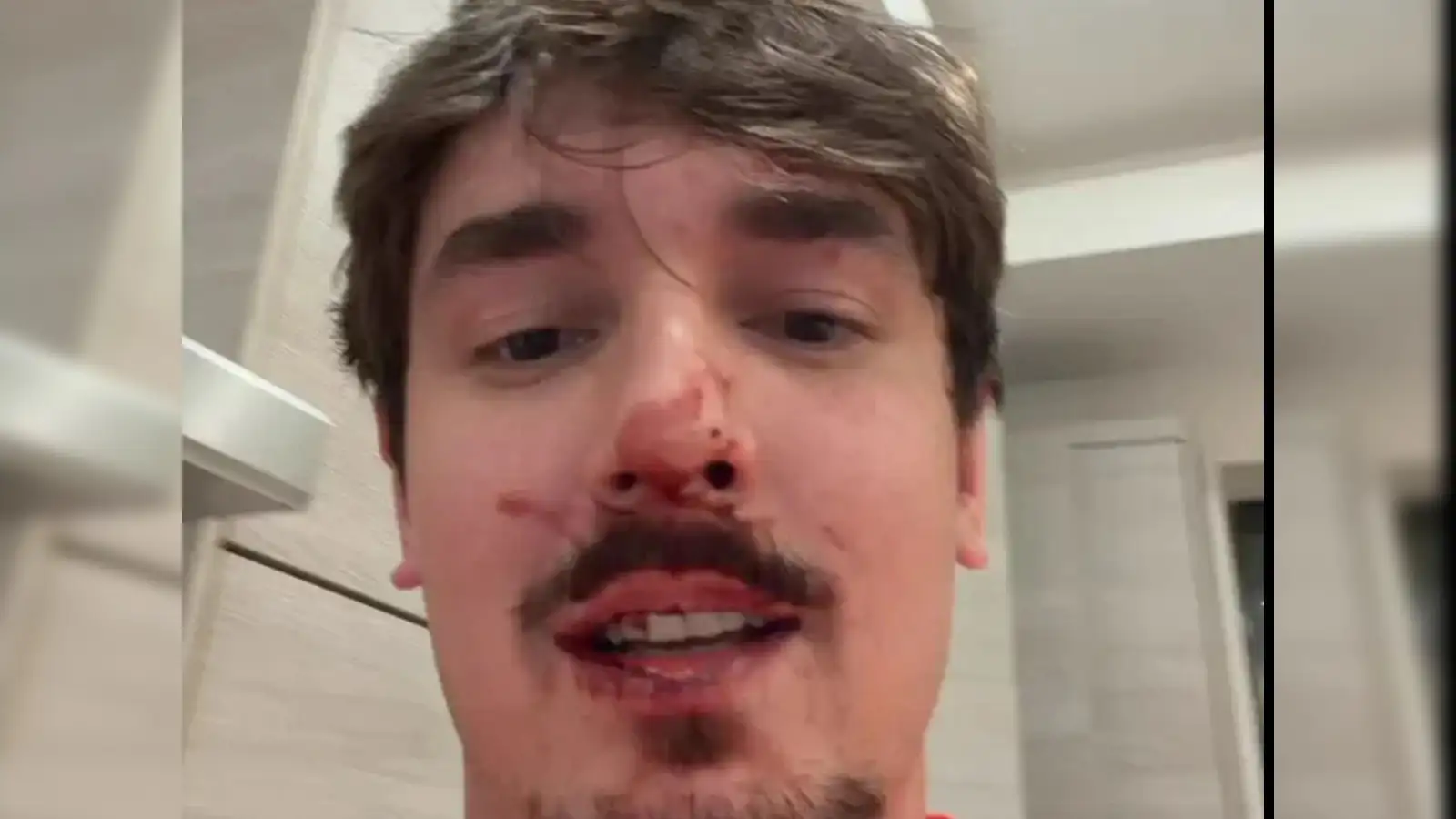 Bryce Hall Injury Update: TikTok Influencer Reveals Facial Injuries Following Halloween Fight