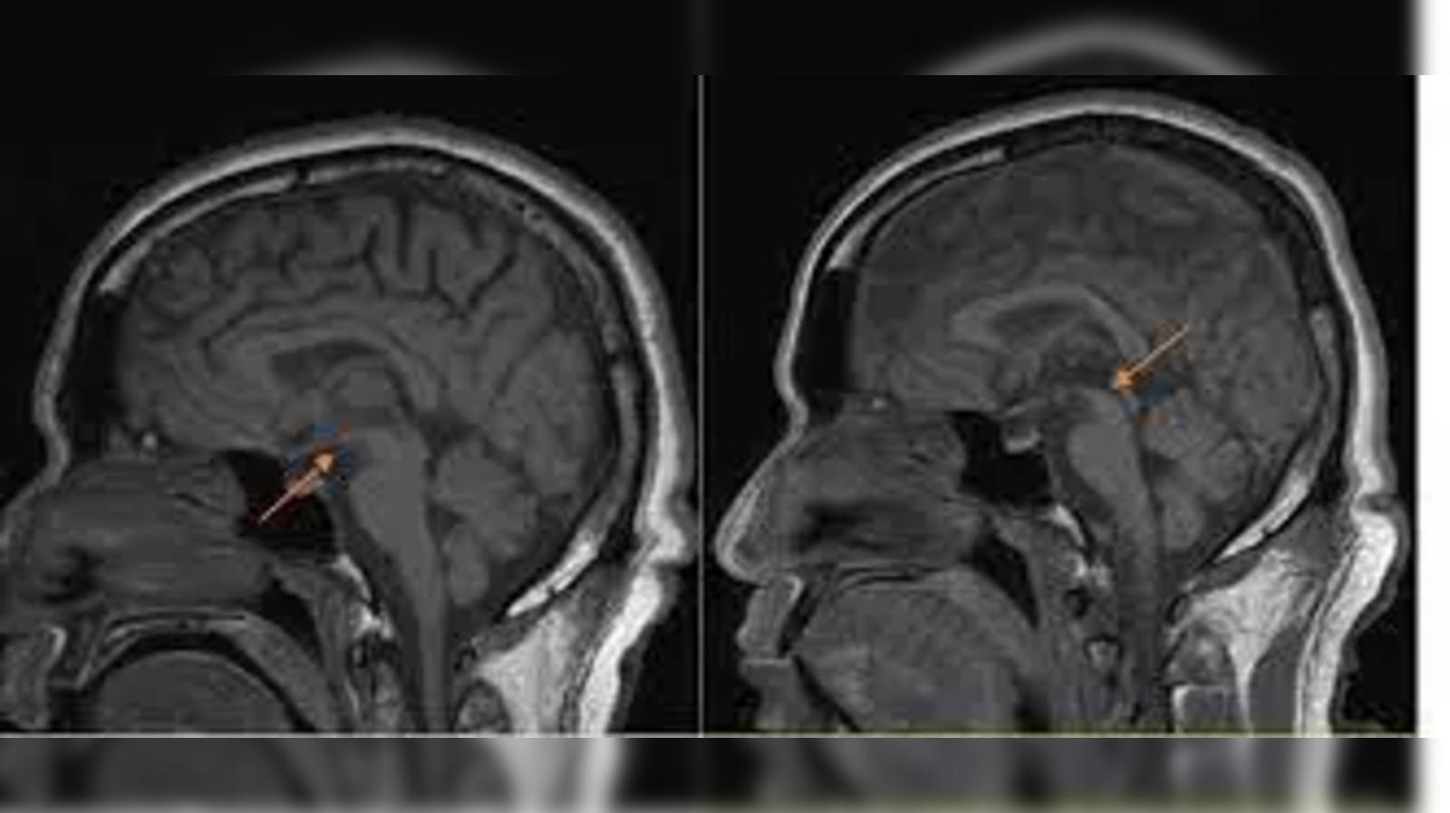 Boy With Rare Brain Disease Treated at GH