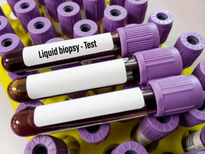 What is liquid biopsy that can detect breast cancer & why it's important for patients undergoing chemo?