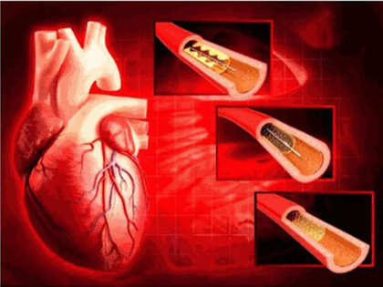 Govt slashes cardiac stent prices by over 75 per cent