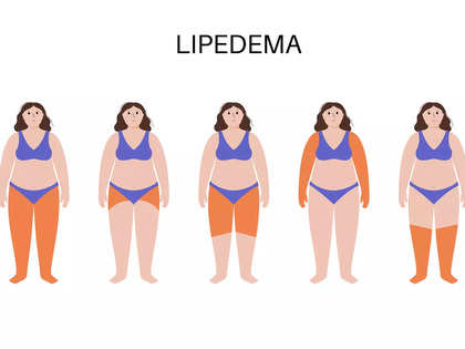 What is Lipedema? What you need to know about the tricky disease