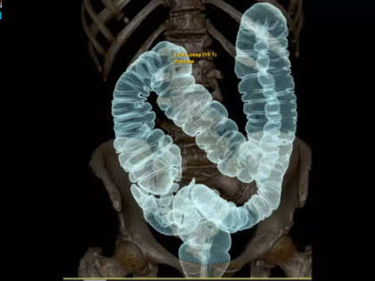 Colon cancer often detected only in advanced stages, 10 % of patients are younger than 50 yrs