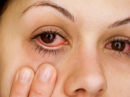 Spike in conjunctivitis cases causes alarm; here's how you can stay safe from 'pink-eyes' flu
