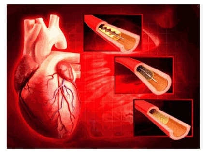 Profit on stents ranges from 270% to 1,000%