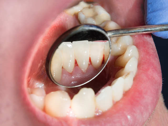 Plaque On Teeth