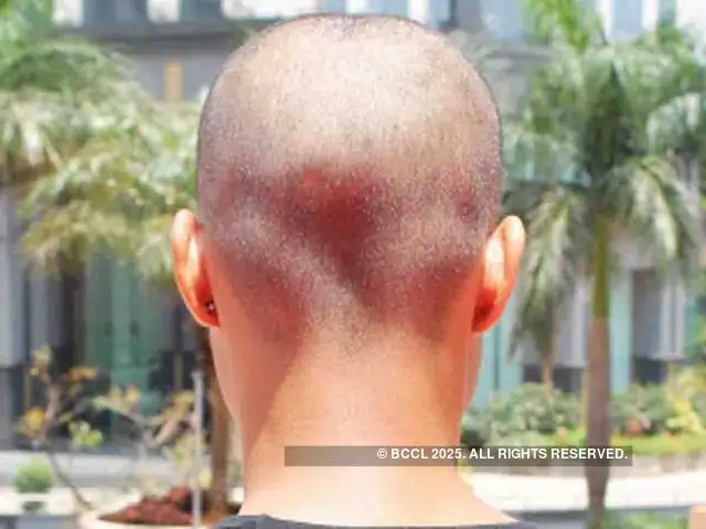 Hair Loss Is Your Hair Loss Treatment Really Effective