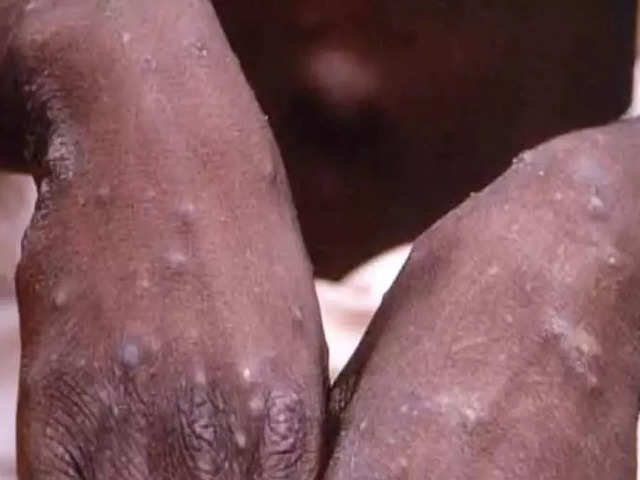 Kerala govt issues guidelines for monkeypox cases